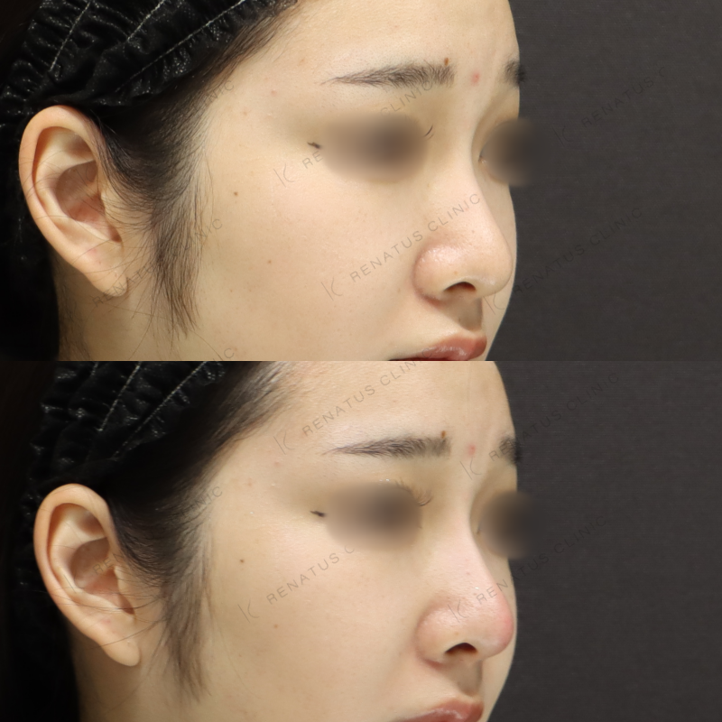 新宿院施術症例写真|レナトゥスクリニック新宿院