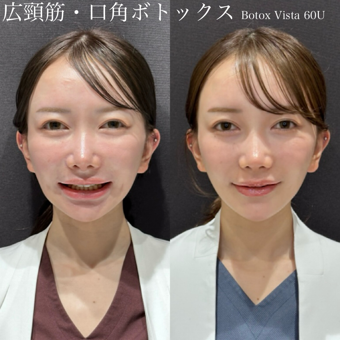 広頚筋・口角BT Botox vista 60U イー 症例写真