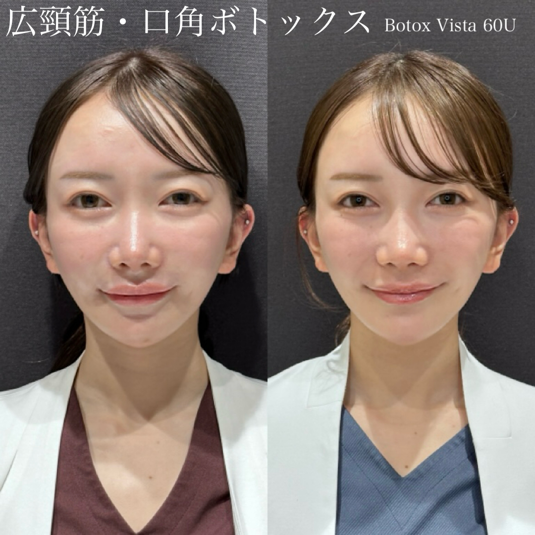 広頚筋・口角BT Botox vista 60U 微笑み 症例写真